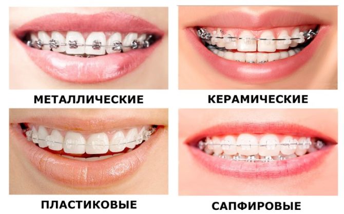 Các loại niềng răng bằng vật liệu