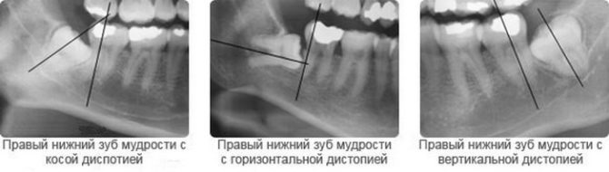 Tipos de distopia dos dentes do siso