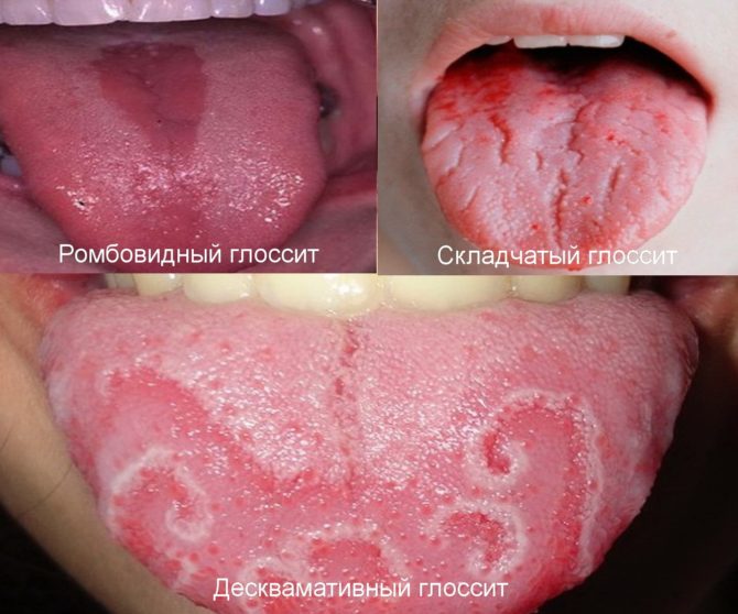 Tipos de glositis con síntomas en forma de grietas en la lengua.