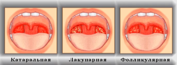 Tipi di mal di gola purulenta
