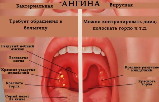 Typer och metoder för behandling av tonsillit