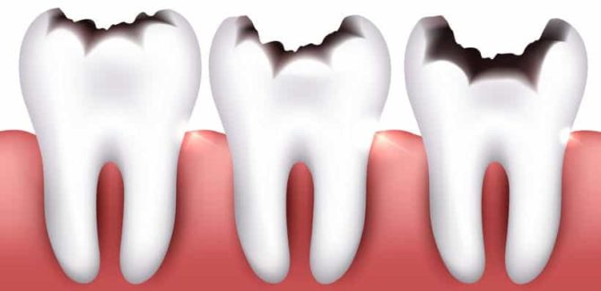Các loại sâu răng