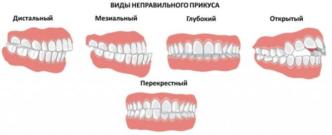 Druhy malocclusion