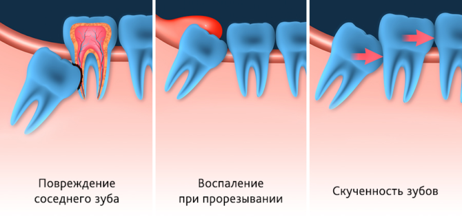 Tipi di saggezza Dentizione