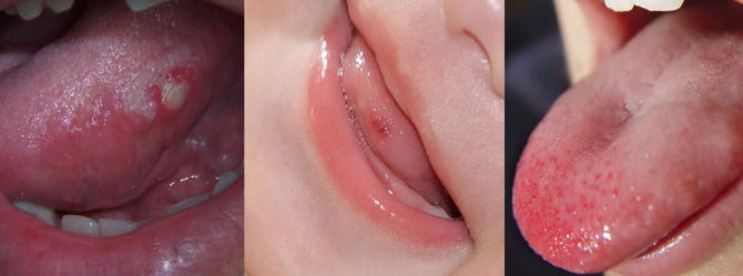 Types of acne in the tongue