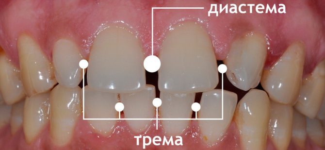 Tipos de espacios entre los dientes.