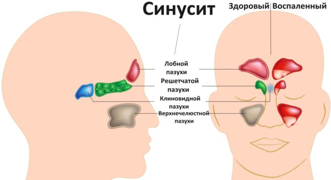 Types de sinusite