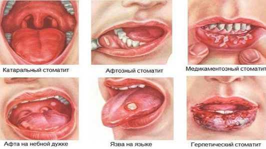 Các loại viêm miệng