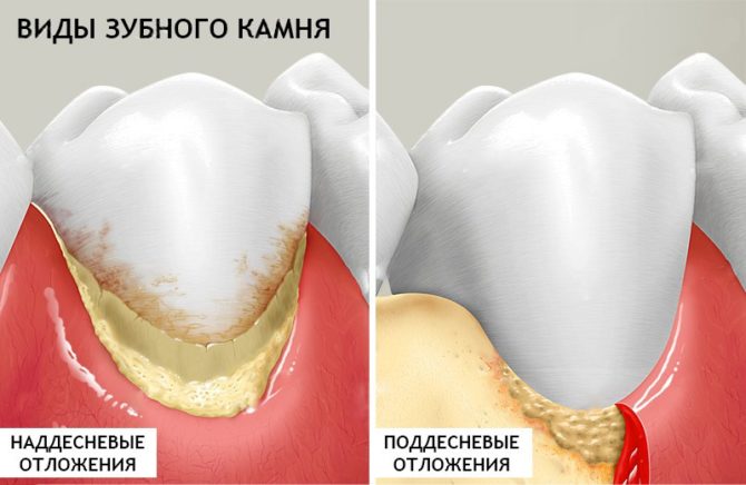 Typer av tandsten
