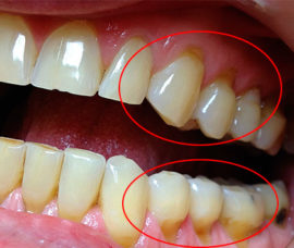 External signs of a wedge-shaped tooth defect