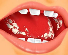 Biểu hiện bên ngoài của bệnh tưa miệng