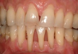 Panlabas na pagpapakita ng periodontitis
