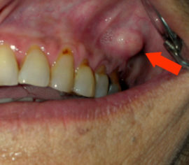 A parodontitis külső megnyilvánulásai