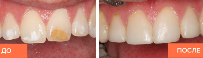 Utseendet på tandprotesen före och efter installationen av sammansatta fanér