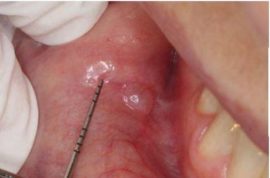Watery pimple in the mouth