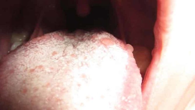 Blisters on the tongue with gingivitis