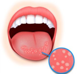 Puchýře na jazyku s kandidální stomatitidou