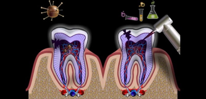 Inflamația rădăcinilor dinților