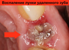 Inflamação do orifício no dente extraído