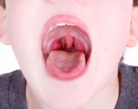 Tonsil gyulladás