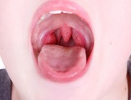 Tonsil inflammation