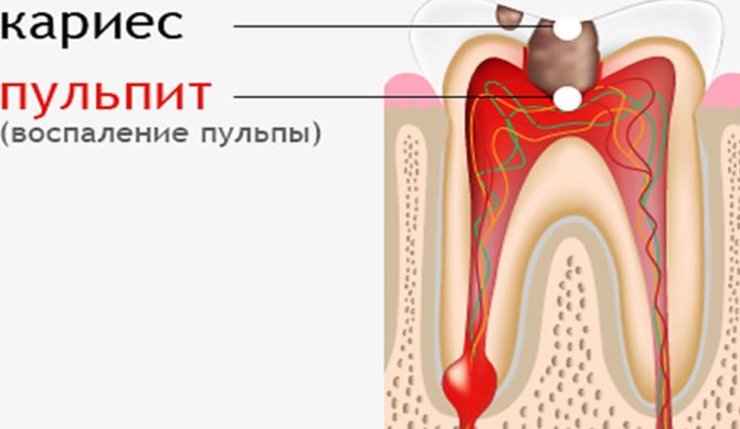 Inflamación de la pulpa dental
