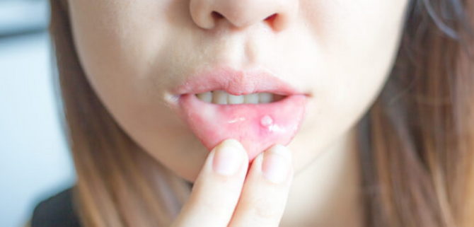 Inflammation of the oral mucosa