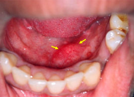 Inflamación de las glándulas salivales