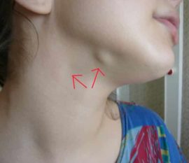 Der Lymphknoten am Hals ist entzündet