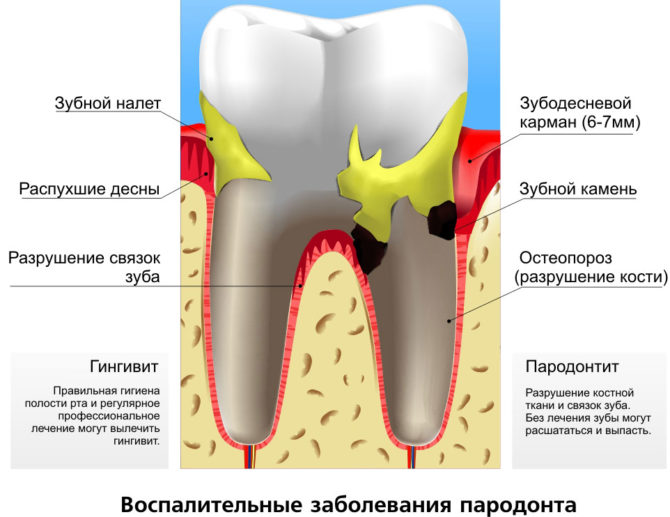 Enfermedad periodontal inflamatoria