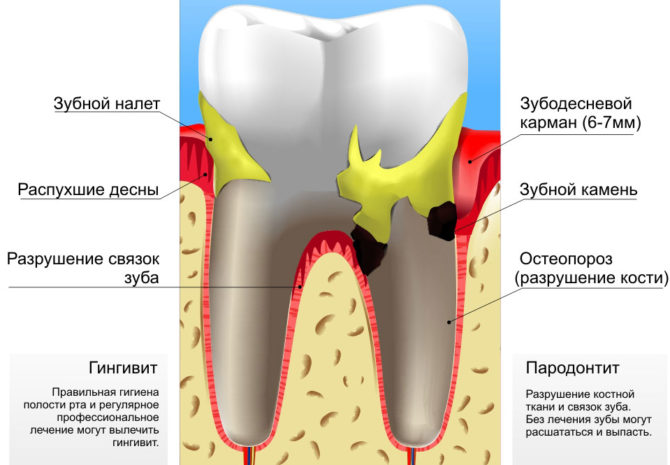 Inflammatoire parodontitis