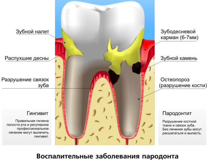 Iekaisuma periodonta slimība