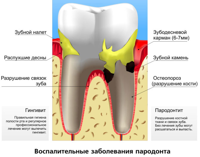 Namamaga na periodontal disease