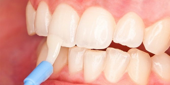 Restaurarea smalțului dinților