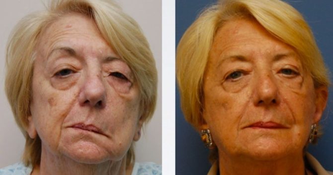 Restauration de l'expression faciale après une névrite