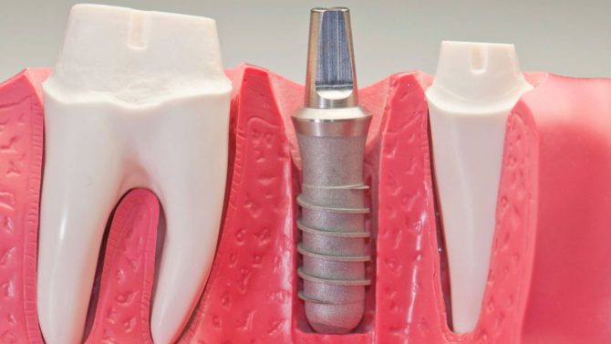 Restauration dentaire avec implant