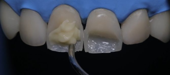 Restauration dentaire avec matériaux composites