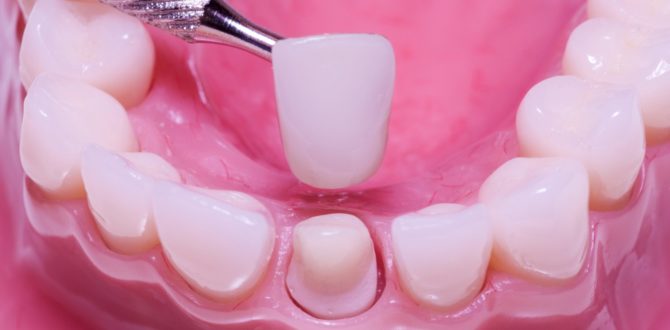 Coroa de restauração dentária