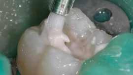 Restauration dentaire avec matériau de remplissage