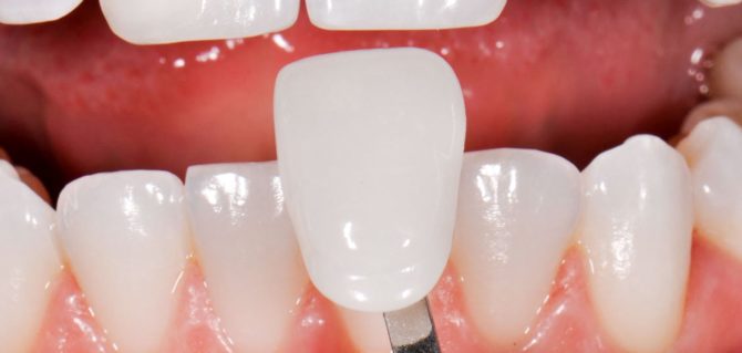 Zahnrestauration mit Veneer