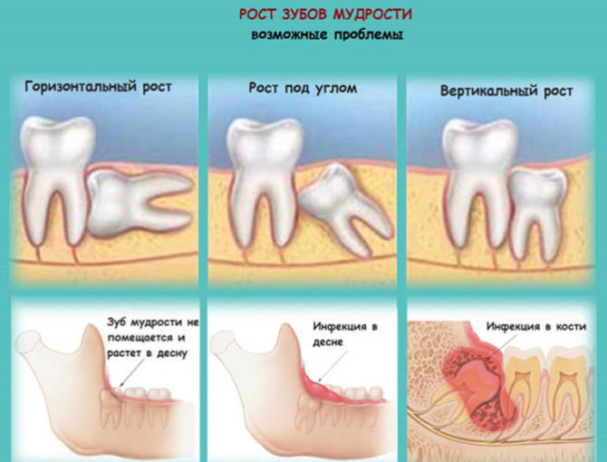 Possíveis problemas durante o crescimento de um dente do siso