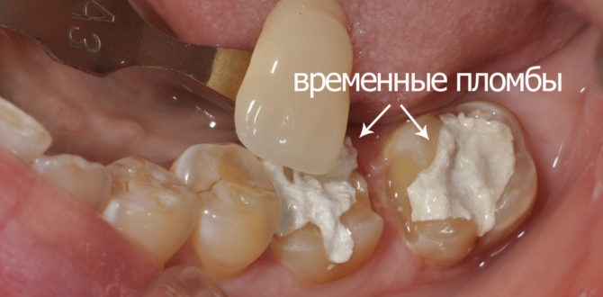 Obturations temporaires dans les molaires