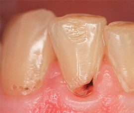 Druhá fáze zubního kazu