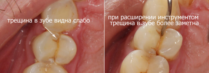 Identification of a crack on a tooth during a dental examination
