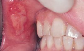 Ulcerative necrotic stomatitis