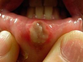 التهاب الفم التقرحي