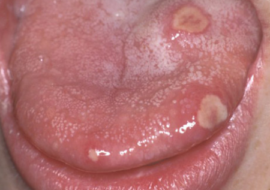 Ulcerative glossitis