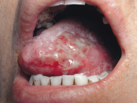 Ulcerozni glositis