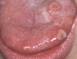Ulcerative glossitis