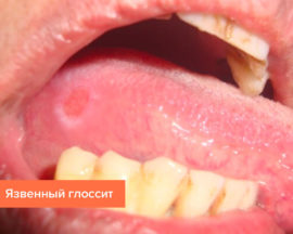Glositis ulcerosa de la lengua.